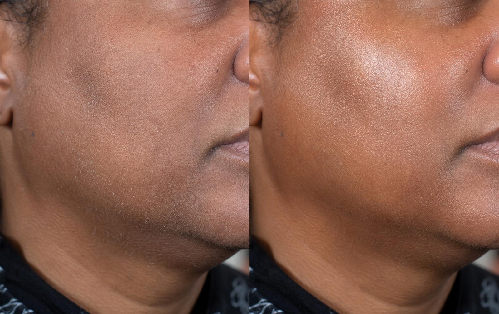 Before and after Pure Dew — Amara, 42 · dry / mature skin