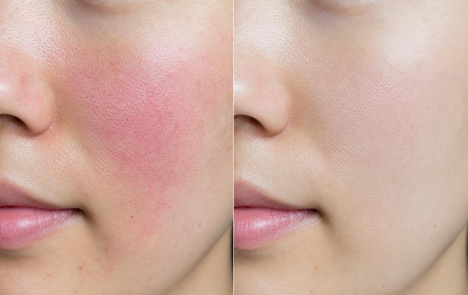 Before and after Rosée — Mei, 26 · sensitive skin